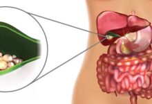 سنگ کیسه صفرا چیست و چگونه درمان میشود؟ راهنمای کامل تشخیص، علائم و درمان سنگ کیسه صفرا چیست و چگونه درمان میشود
