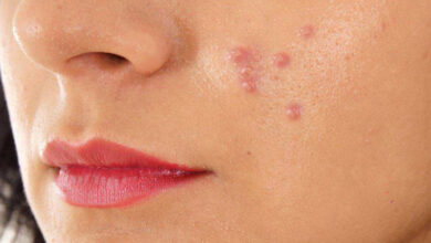 از ارتباط بین آکنههای پوستی با قند و شکر چه میدانید؟ از ارتباط بین آکنههای پوستی با قند و شکر چه میدانید؟