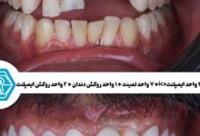 چرا اختلاف قیمت ایمپلنت دندان در شیراز زیاد است؟ راهنمای تشخیص قیمت واقعی از قیمتهای تبلیغاتی چرا اختلاف قیمت ایمپلنت دندان در شیراز زیاد است؟ راهنمای تشخیص قیمت واقعی از قیمتهای تبلیغاتی